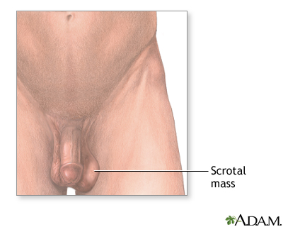 Scrotal mass Scrotal mass