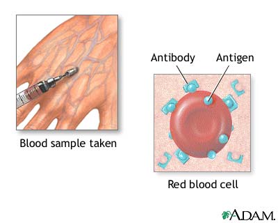 Herpes blood test Herpes blood test