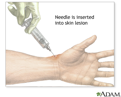 Skin lesion aspiration Skin lesion aspiration