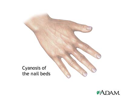 Cyanosis of the nail bed Cyanosis of the nail bed