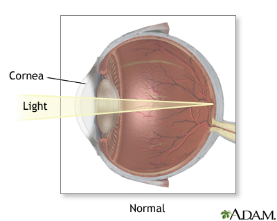 Normal vision Normal vision
