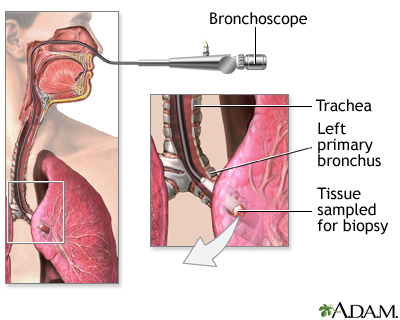 Bronchoscope Bronchoscope