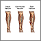Bone fracture repair - series