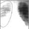 Aortic rupture - chest X-ray
