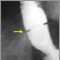 Schatzki ring - x-ray