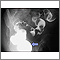 Sigmoid colon cancer - X-ray