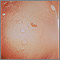 Impetigo - bullous on the buttocks