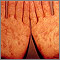 Syphilis - secondary on the palms