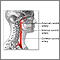 Carotid artery surgery - series