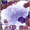 Gaucher cell - photomicrograph