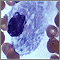Gaucher cell - photomicrograph #2