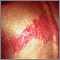 Herpes zoster (shingles) on the back