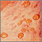 Bullous pemphigoid - close-up of tense blisters