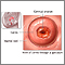 Cervical erosion