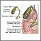 Choledocholithiasis