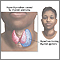 Goiter