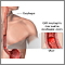 CMV esophagitis