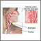 Candidal esophagitis