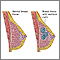 Fibrocystic breast change