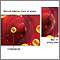 Blockage in internal carotid artery