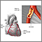 Atherosclerosis
