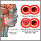 Carotid dissection