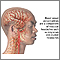 Vascular headaches