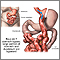 Roux-en-Y stomach surgery for weight loss