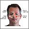 Chronic sinusitis