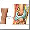 Baker cyst