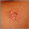 Necrobiosis lipoidica diabeticorum - abdomen
