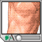 Osteoarthritis Osteoarthritis