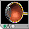 Glaucoma Glaucoma
