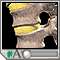 Herniated nucleus pulposus (slipped disk) Herniated nucleus pulposus (slipped disk)
