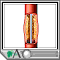 Percutaneous transluminal coronary angioplasty (PTCA) Percutaneous transluminal coronary angioplasty (PTCA)