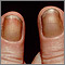 Yellow nail syndrome