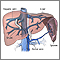 Transjugular intrahepatic portosystemic shunt