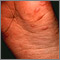 Hand, foot, and mouth disease on the foot