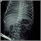 Totally anomalous pulmonary venous return - X-ray