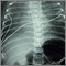 Totally anomalous pulmonary venous return - X-ray