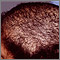 Trichotillomania - top of the head
