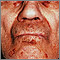 Amyloidosis of the face
