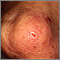 Dermatitis - herpetiformis on the knee