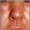 Edema - central on the face