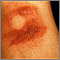 Fixed drug eruption - bullous