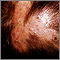 Folliculitis - decalvans on the scalp