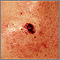 Skin cancer - close-up of level IV melanoma