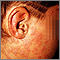 Psoriasis - guttate on the cheek
