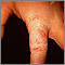 Ringworm - tinea manuum on the finger