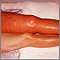 Deep venous thrombosis - iliofemoral